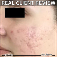 Derma Roller 1mm