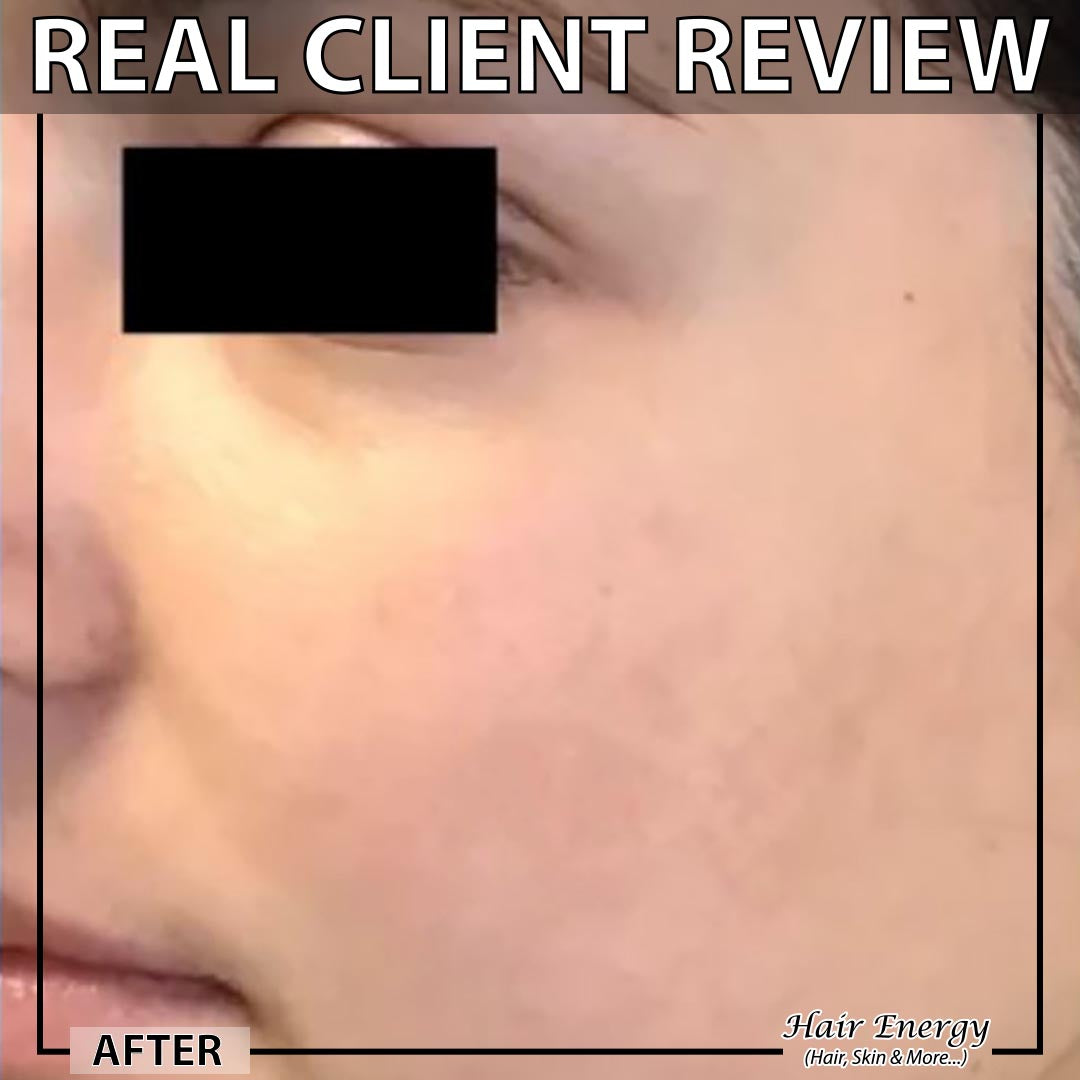 Derma Roller 1mm